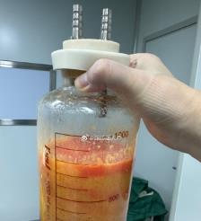 扬州水动力吸脂手术要做多久？